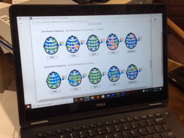 QEEG Brain Map Analysis